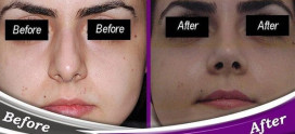 بعد از جراحی بینی