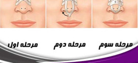 چسب زدن بینی بعد از عمل