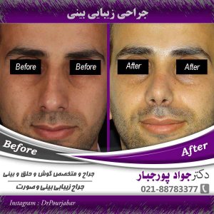 جراحی بینی کج