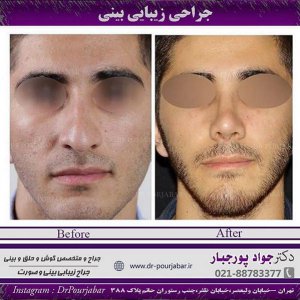 دستورات قبل و بعد از جراحی بینی