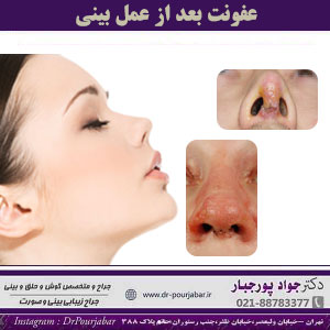 عفونت بعد از عمل بینی