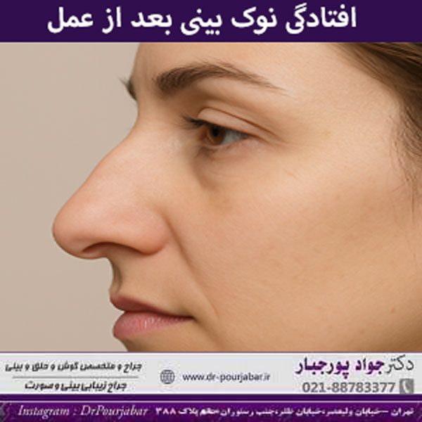 افتادگی نوک بینی بعد از عمل