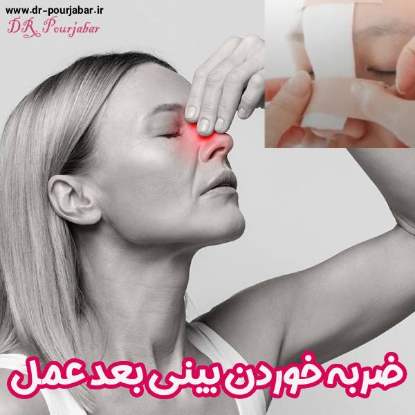 عکس ضربه خوردن بینی بعد عمل - دکتر جواد پورجبار