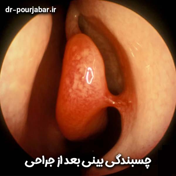 چسبندگی بینی بعد از جراحی