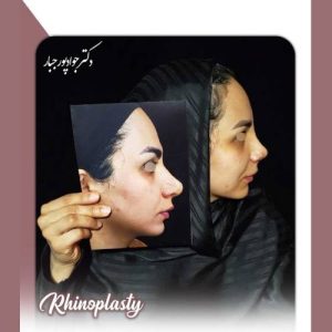 جراحی-بینی-211