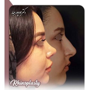 جراحی-بینی-213