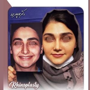 جراحی-بینی-212