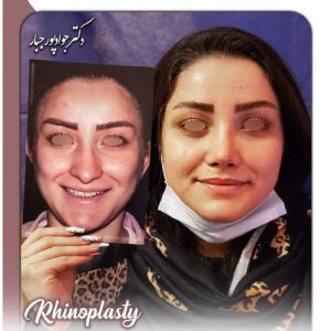 جراحی-بینی-213